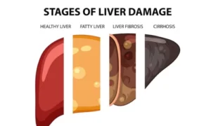 Chronic Liver Disease Treatment in Kochi Guide